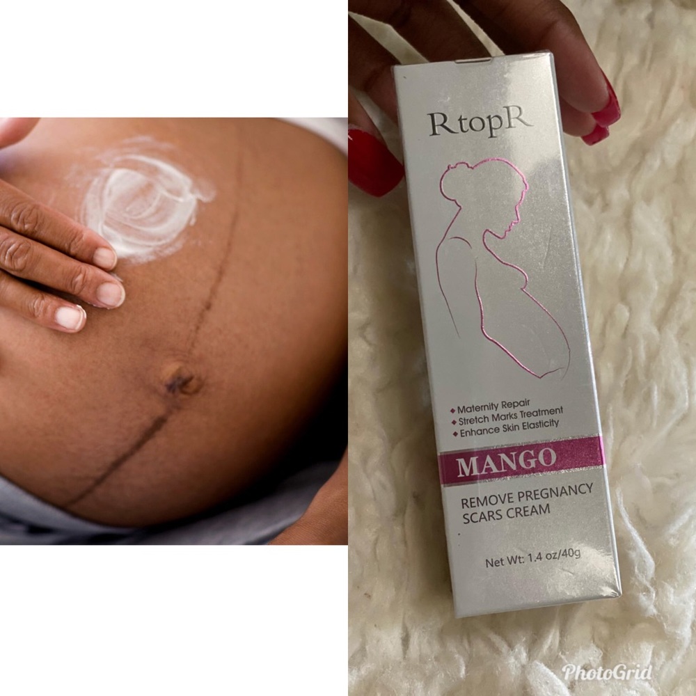 Stretch mark lotion for pregnancy